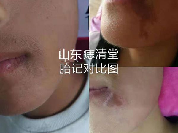 胎記祛除案例